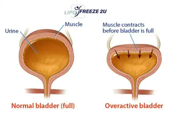 diagram of overactive bladder treatment Harlow