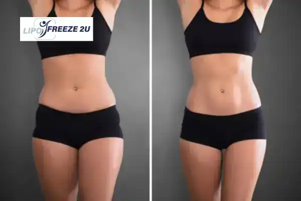 How Can LIPO FREEZE 2U Support Your Post-Pregnancy Body Recovery Harlow?