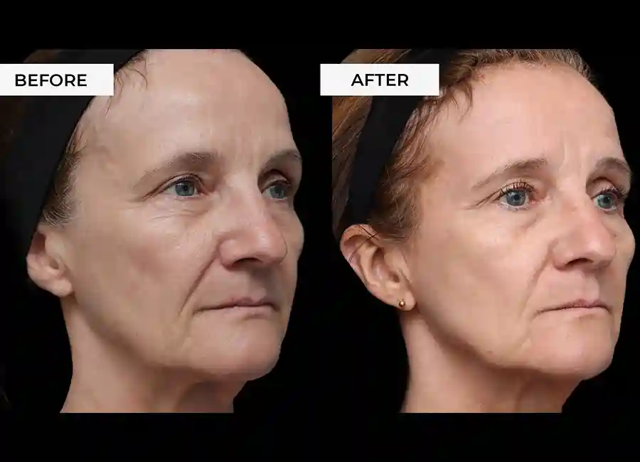 How Many RF Microneedling Sessions Will You Need to See a Difference Harlow?