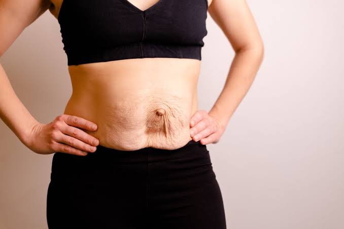 Is Surgery Really the Only Way to Repair Diastasis Recti Harlow?