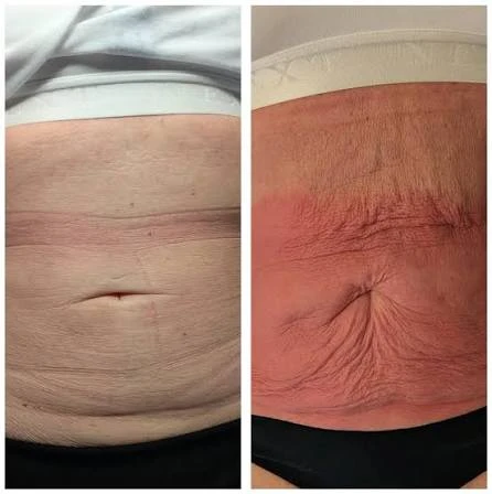 How Does RF Microneedling Improve Crepey, Thin and Uneven Skin Texture Harlow?