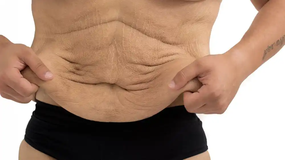 Why Does Weight Loss Medication Leave Some People With Loose or Sagging Skin Harlow?